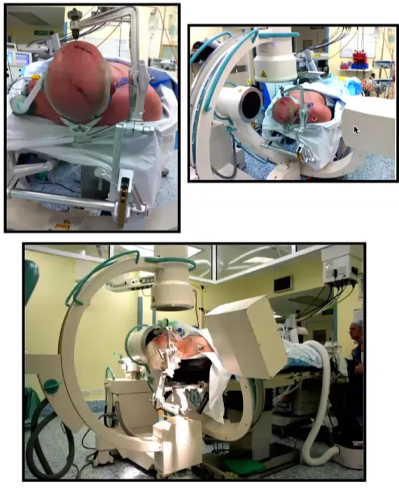 Odontoid Peg Screw Mayfield Clamp & Fluoroscopy Setup Biplanar Fluoroscopy — Book ahead I Reduce Fracture and fix in Mayfield clamp • Traction to disimpact, • Extend/flex to reduce Anterior Displacement (Trans-oral finger pressure) Optimise Lateral and AP views before scrubbing Mark floor: AP Fluoroscopy machine before retracting "40 minutes setup, 30 min surgery" 
