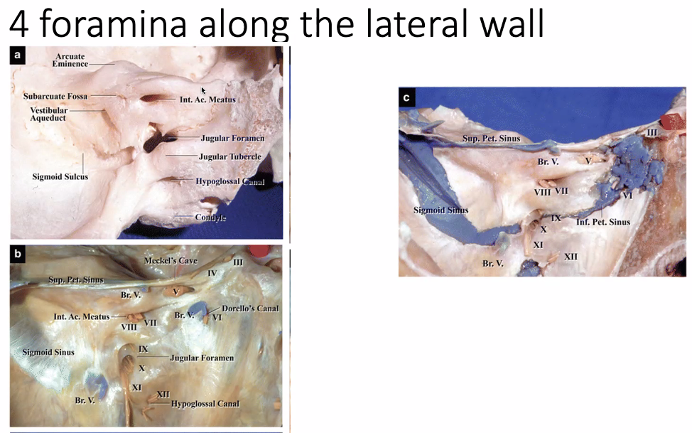4 foramina along the lateral wall Vestibular nid 