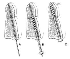 Odontoid Screw Fixation