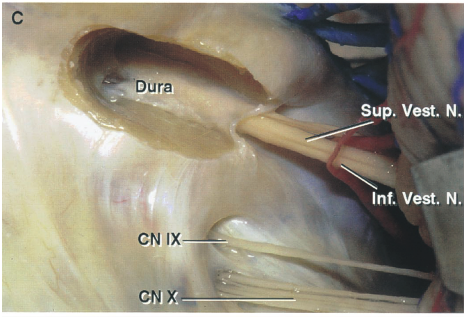Dura sup. Vest. N. Inf. Vest. N. CN IX 