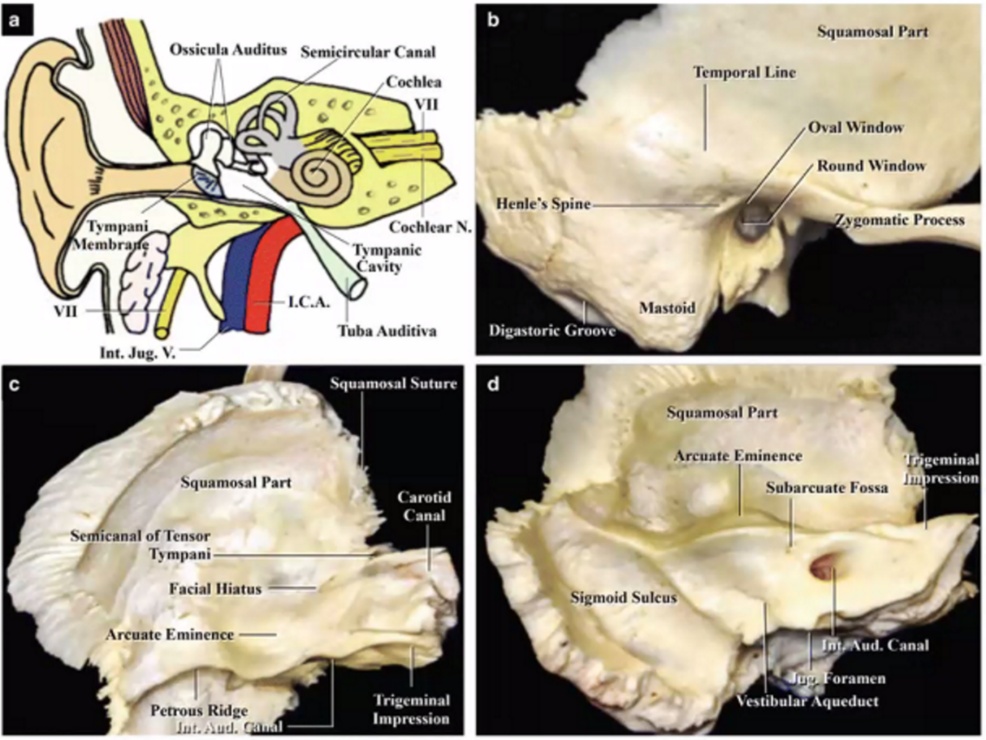 (b,sicula Auditus Tympani 1 Int. Joe. V. Canal Cochlear N. •avity I-C.A. Tuba Auditiva Digastoric e Squamosal Part anal Of Tensor mpani Facial Ili•tus Areuate Eminence Petrous Ridze squamosal Suture Carotid Canal Trigeminal Impression Squamosal Part Temporal Line oval Round "indow ,ygomatic Process Squamosal part Arcuate Eminence Subarcuate Fossa "d. Canal Vestibular 