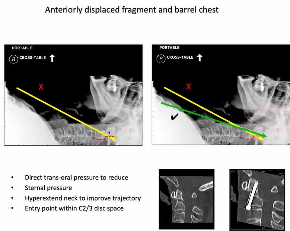Anteriorly displaced fragment and barrel chest PORTABLE R CROSS-TABLE PORTABLE R CROSS-TABLE • Direct trans-oral pressure to reduce Sternal pressure Hyperextend neck to improve trajectory Entry point within C2/3 disc space 