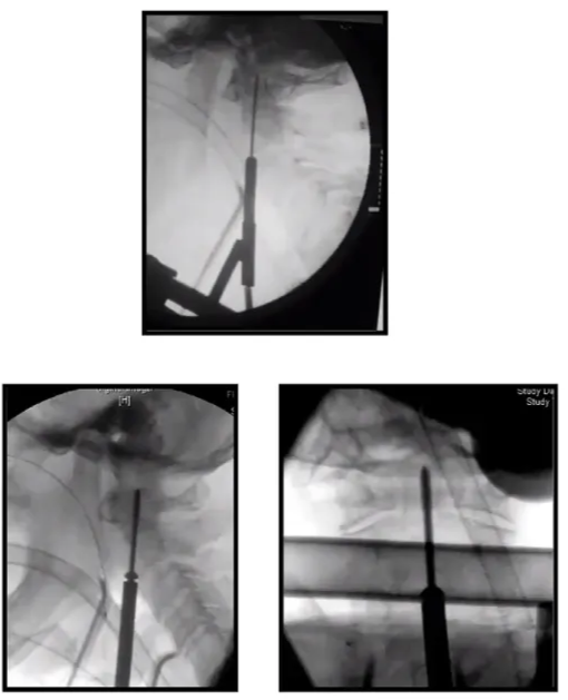 Odontoid Screw Surgical Technique Standard approach to G4/5 Dissect up prevertebral plane to C2/3 disc 