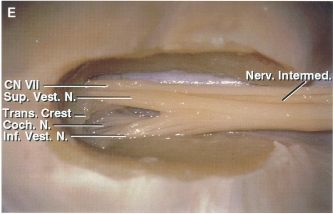 Nerv. Intermed. CN Vil Sup. Vest. N. rans. Crest —s' Coch. N. Inf. vest. N. 