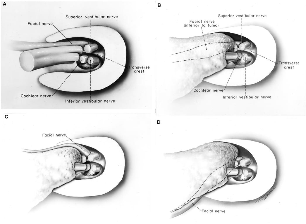 Superior vestibular nerve Facial nerve anterior to tumor Facial nerve Cochlear nerve Superior vestibular nerve Inferior vestibular nerve ransverse crest ansverse crest Cochlear nerve Inferior vedtibular nerve c Facial nerve SFacial nerve 