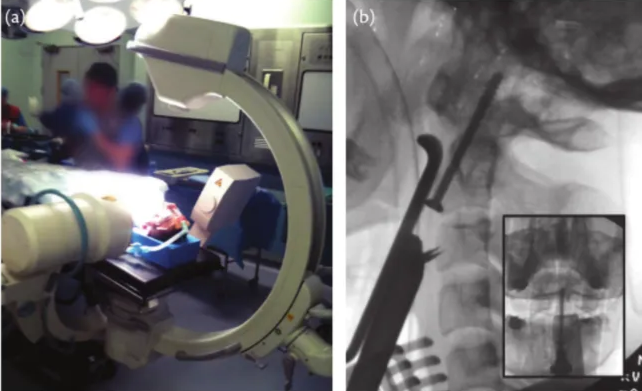 Fig. 68.10 (A) Two image intensifiers set up to Obtain simultaneous Images Of the Odontoid peg •n both planes and the extended position Of the cervical spine (8) Intraoperative lateral and AP radioeraph showing the position of the retractor. screw wide. and a sinxle lag screw in position. 