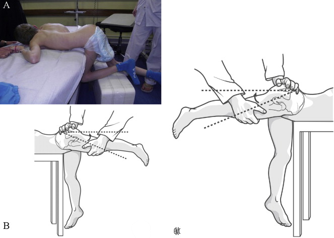 Clinical hip examination with flexion contracture measurement in ventral decubitus with pelvis at table edge. A. Clinical photograph of child's position. B. Diagram of flexion contracture measurement.