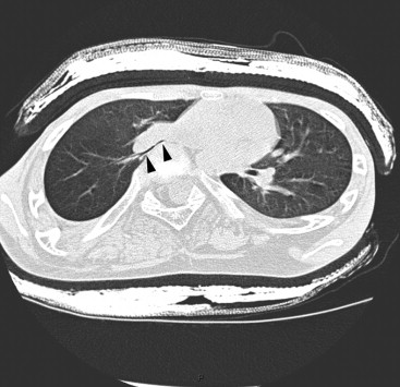 CT slice confirming right middle lobe bronchus stretching (arrows) in contact with vertebral body in girl with evolutive scoliosis with thoracic lordosis.