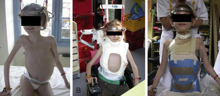 Conservative treatment sequence for severe spinal deformity with pelvic obliquity in a 9-year-old girl with spinal amyotrophy. A. Correction begins with progressive axial traction by cranial halo. B. Supplementary correction of pelvic obliquity and trunk collapse by detraction cast. C. Stabilization of correction in Garchois corset with occipitomental extension.