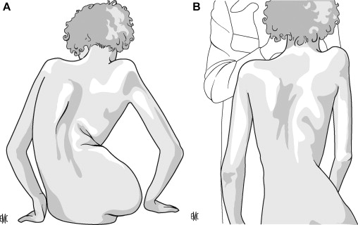 Clinical reducibility of collapse can be explored by manual trunk elongation in seated posture.