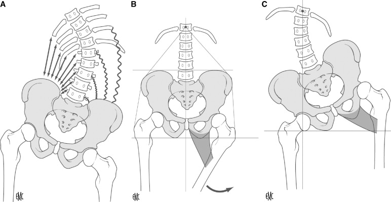 Neuromuscular scoliosis of upper origin (A) and lower origin (B and C).