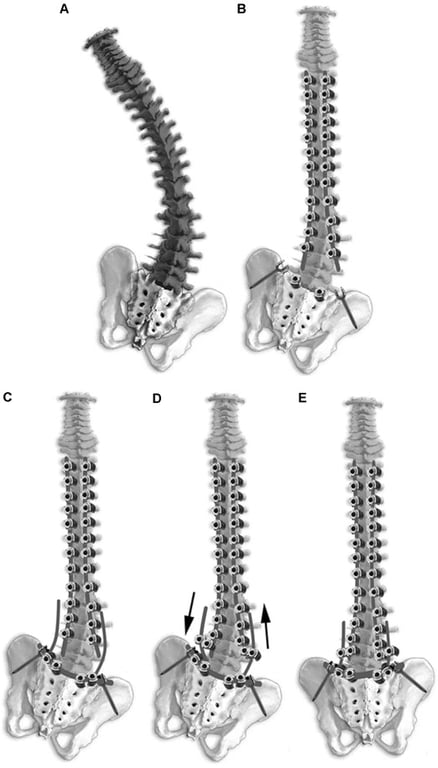 Surgical correction strategy in neurological scoliosis with pelvic obliquity by segmental T-assembly. A and B. Correction of spinal deformity. C. Pelvic instrumentation with 21 pedicle screws in sacrum and two in the iliac wings, connected by a horizontal rod. D. Correction of pelvic obliquity by union connectors between pelvic and spinal assemblies. E. Final result after implant locking.