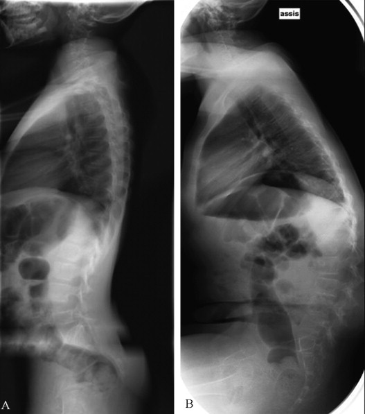Evolution of postural hypotonia leading progressively to lumbar kyphosis in a boy with Duchenne muscular dystrophy. A. Lateral spinal X-ray, standing, age 8 years. B. Lateral spinal X-ray, seated, age 10 years.