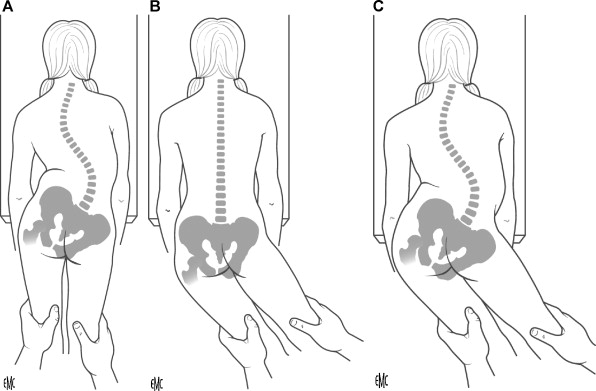 A. Spontaneous position, with pelvic obliquity and hip malpositioning. B. Good pelvic obliquity reducibility. C. Incomplete pelvic obliquity reducibility under asymmetric left lower limb traction.