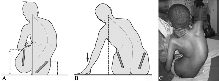 Pelvic obliquity inducing asymmetric stress to ischial weight-bearing points in seated posture. A. Imbalance with excess right ischium pressure. B. Compensatory trunk imbalance by upper limbs. C. Upper limb compensation impossible, requiring help from another person to maintain upright trunk.