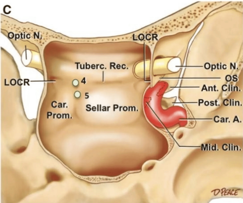 Oblique-anterior view of a sphenoid bone. 