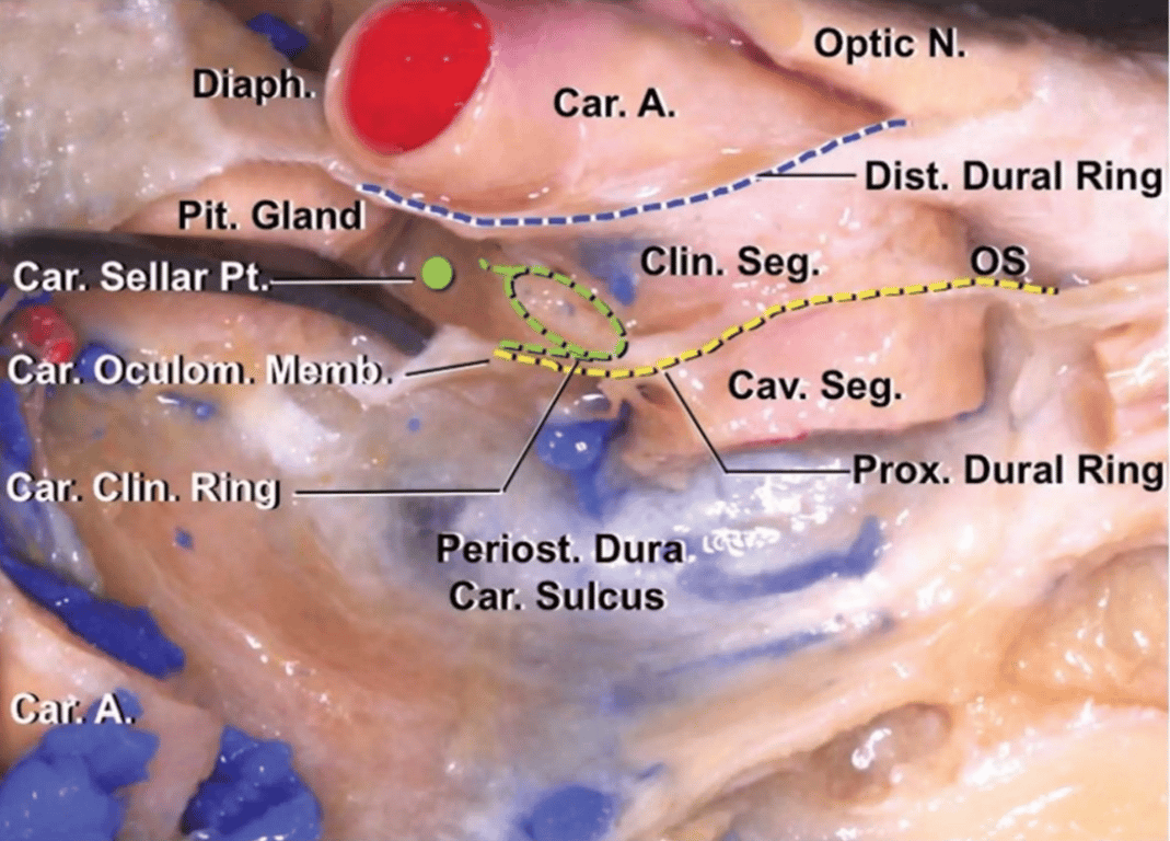 Lateral view of the medial wall of the right cavernous sinus in a specimen with a caroticoclinoid ring (green dotted lines)