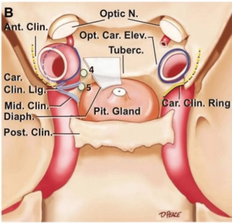 Intracranial view showing the anterior, middle and posterior clinoid processes. 
