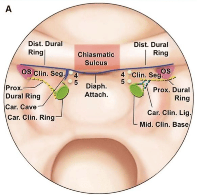 Endoscopic endonasal view of the sellar wall of the sphenoid sinus. 