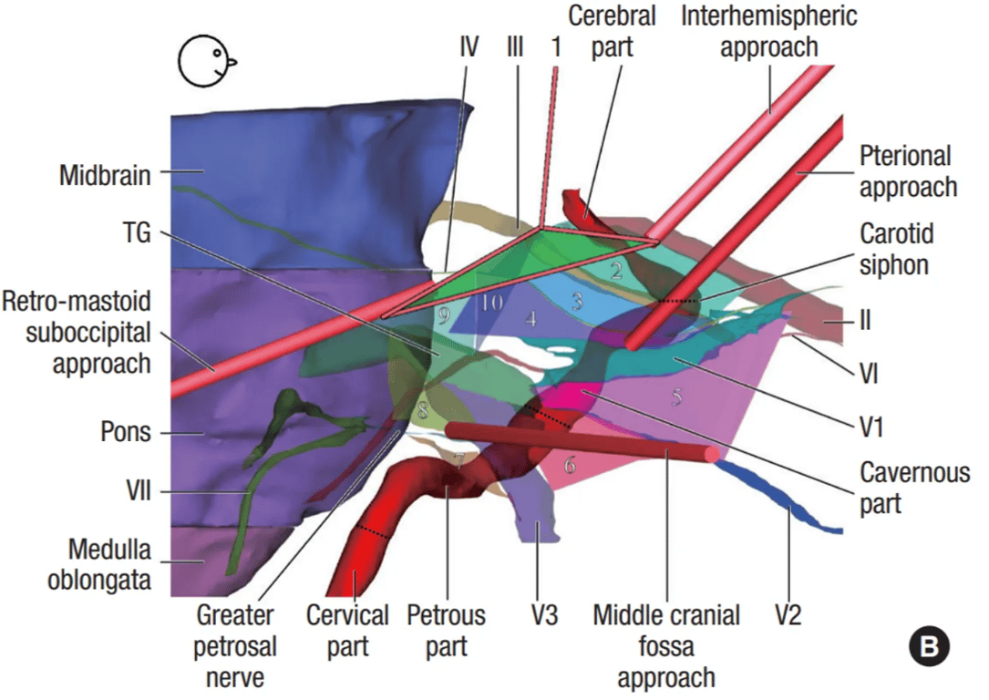 On the three dimensional models, interhemispheric approach, pterional approach, middle cranial fossa approach, and retromastoid suboccipital approach are demonstrated to access the internal carotid artery.