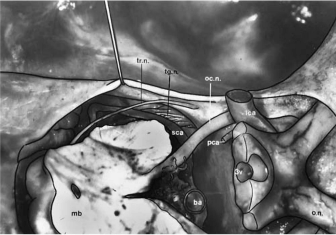 Oblique view of the left tentorial incisura (lateral space) showing its neurovascular structures. 
The left tentorial edge is elevated with a dissector, displaying the trochlear nerve (tr.n.) running parallel to the tentorial margin to its entrance into the cavernous sinus. 
The oculomotor nerve (oc.n.) enters into the roof of the cavernous sinus. 
Beneath the trochlear nerve, the trigeminal nerve (tg.n.) passes through Meckel’s cave. Note the close relationship between the trigeminal nerve and the superior cerebellar artery (sca). 
Basilar artery (ba); internal carotid artery (ica); midbrain (mb); optic nerve (o.n.); posterior communicating artery (pca); and third ventricle (3v).