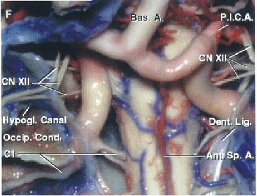 as. A. N XII Hipogl- Canal' b, P.I.C.A. Dentr Lige 