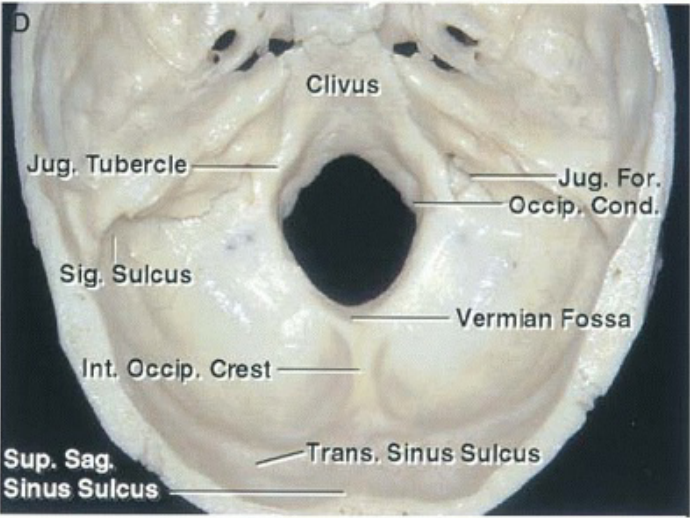 Clivus Jug. Tubercle For. Cond- Sig. Sulcus Vermian Fossa Int. 9ccip. Crest Sup. Sag Sinus Sulcus ——— Trans. Sinus Sulcus 
