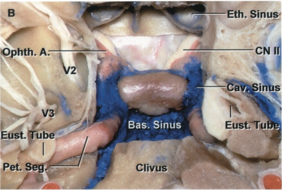 Inferior view of the sphenoid as it is being dissected away 