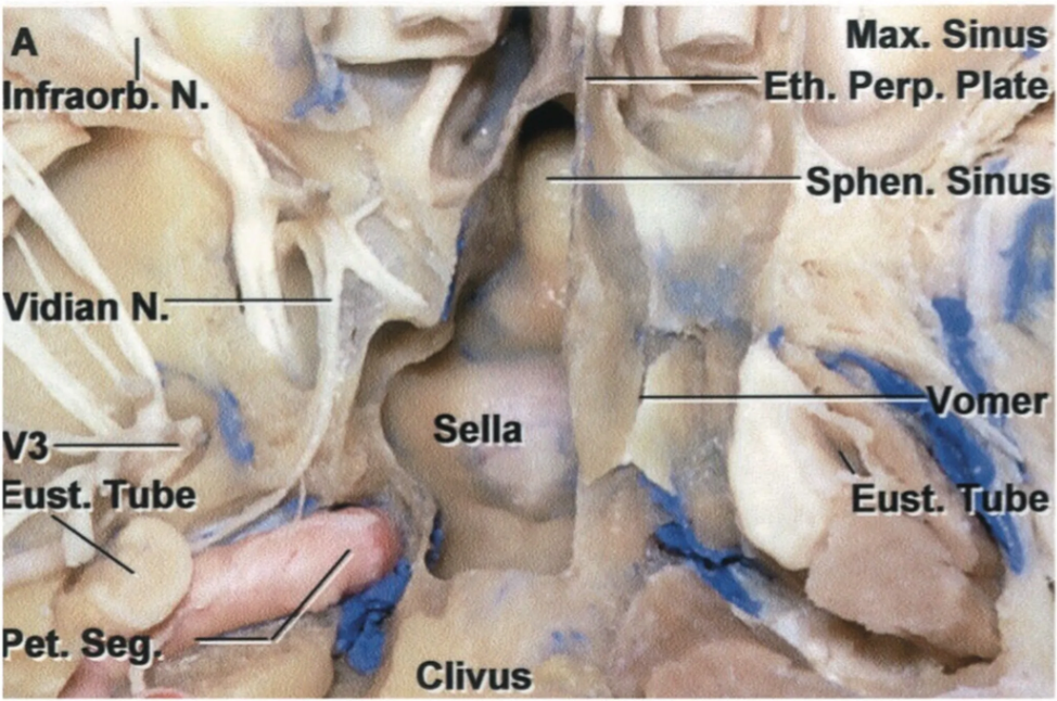 Inferior view of the sphenoid as it is being dissected away 
