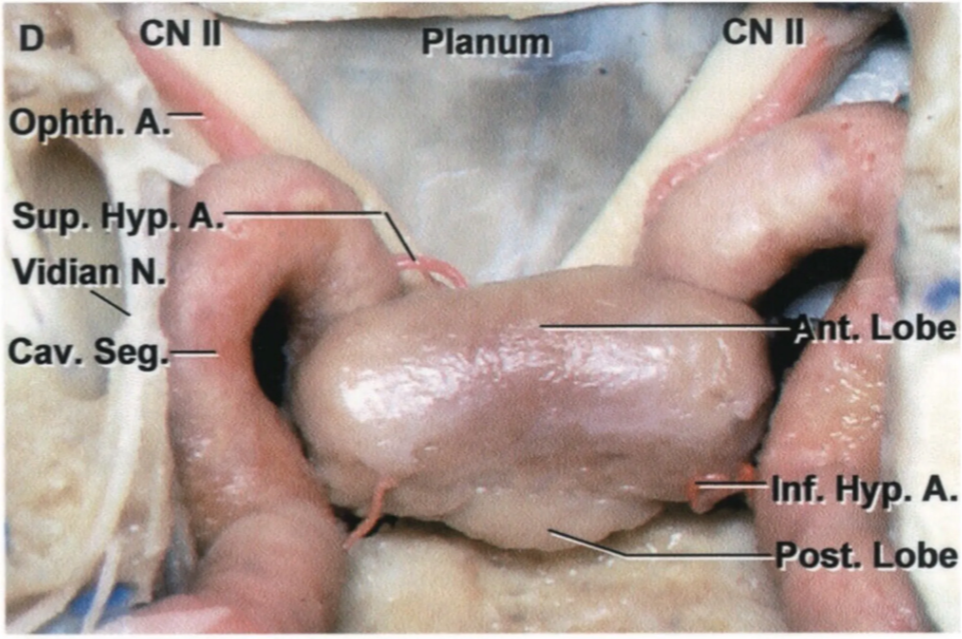 Inferior view of the pituitary after the bony sella has been removed 