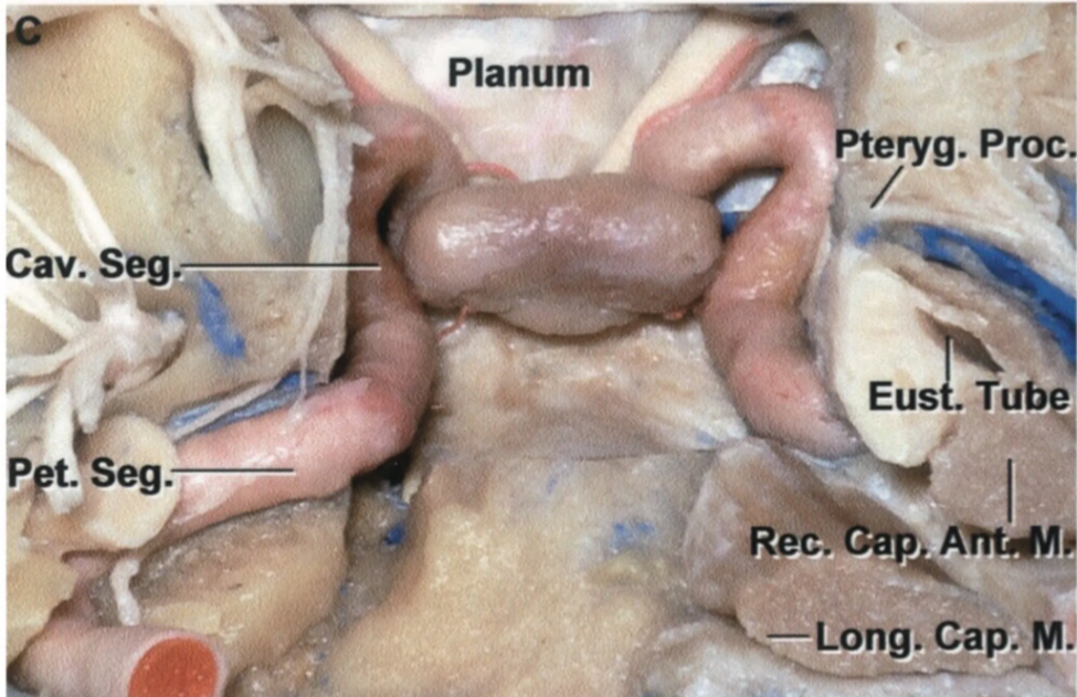 Inferior view of the sphenoid as it is being dissected away 