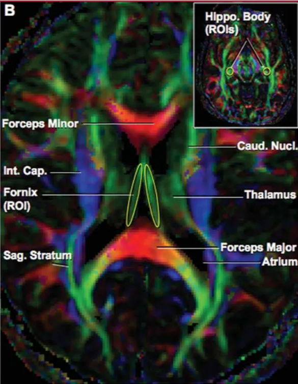 Co.' oml Minor å!amus Imb a Fornlx mgm Wnor Cap. — (ROD Sag. HWpo. Caud. Nucl. Thalunus Forceps Major 