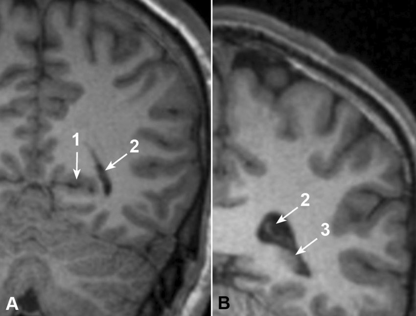 Coronal MRI passing through the anterior part of the calcarine sulcus (a) and the calcar avis (b). 1—Anterior part of the calcarine sulcus. 2—Occipital horn of the lateral ventricle. 3—Calcar avis