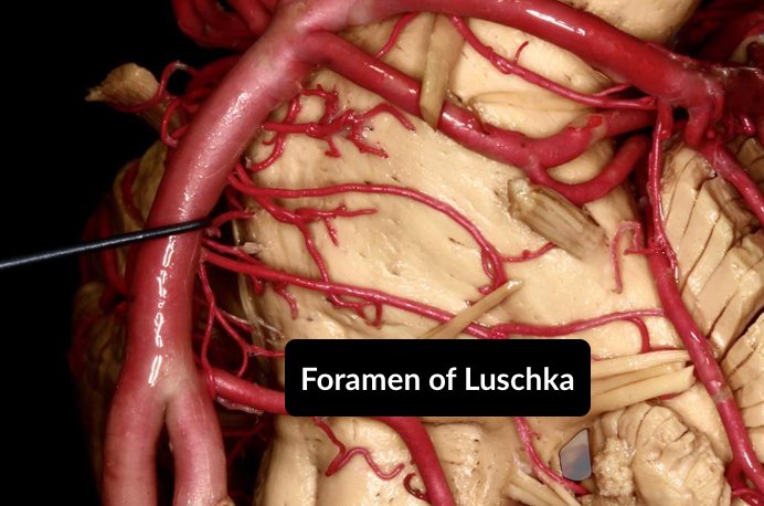 Neurosurgical Atlas on Twitter: "Congrats to all those who correctly guessed the foramen of luschka! The foramen is located just posterior to the root of the glossopharyngeal nerve and is the lateral