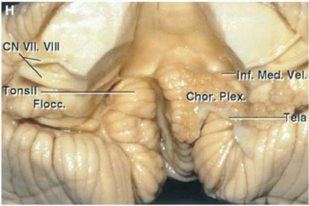CN VII, VIII ons Flocc. . Med Chpr. Plex 