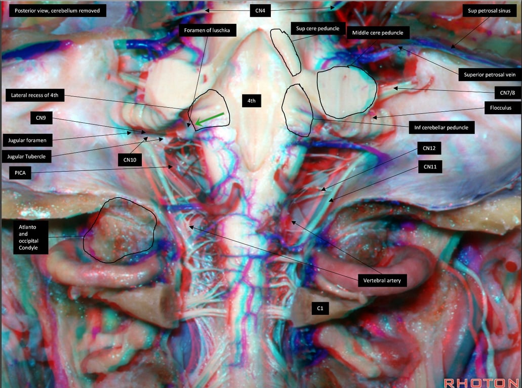 Posterior view, ærebellum remwed Lateral reæss of 4th Jugular Tube xle Atlanta o«iptal condy*e of luschka Sup cere pedunde Sup petmsal sinu Middle c cw/8 Inf cerebellar pedunde CN12 ano CNII Venebral artery 