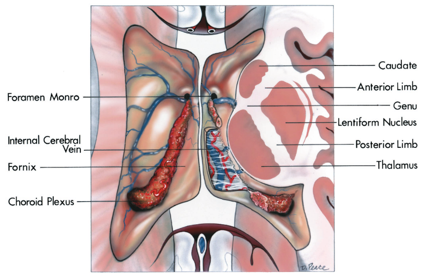 Foramen Monro hternal Cere&al Vein Fornix Pkxus Caudate Anterior Limb Lentiform Nucleus Posterior Lirnb Tha [amus 