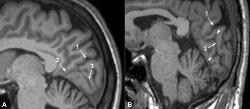 Sagittal MRI showing. a Discontinuous character of the calcarine sulcus; b collateral branches along its course (white arrowheads). 1—Parieto-occipital fissure. 2—Anterior part of the calcarine sulcus. 3—Calcarine sulcus proper