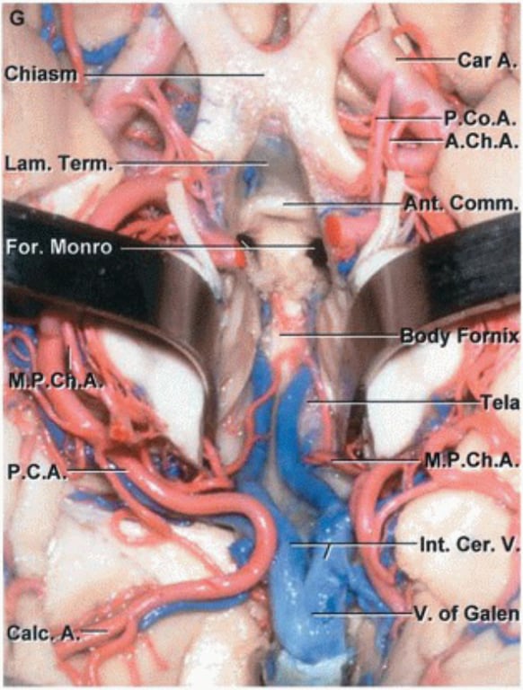 Car Chiasm Lam. Term. Comm. For. Monro rTe1a .Ch P,c.m_. Int. Cer. alc 