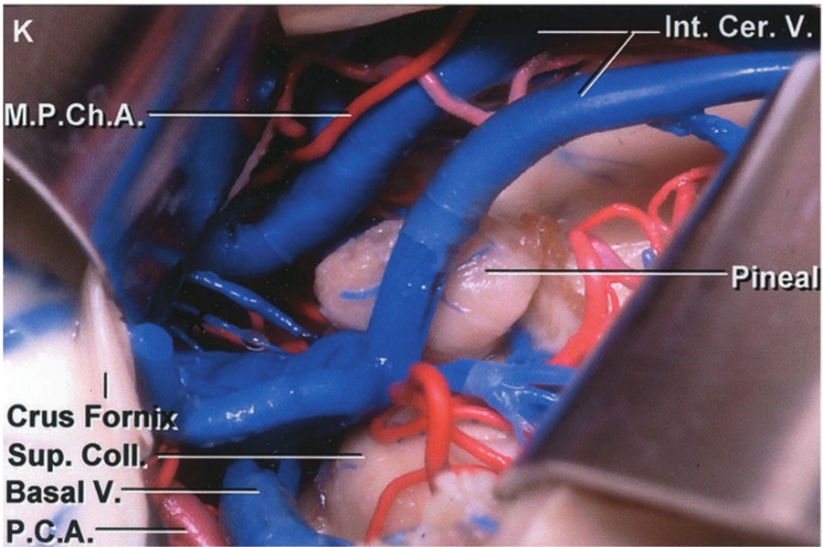 Int. Cer. V. M.P.Ch.A. Pineal Crus For sup. coli' Basal V. P.C.A. 