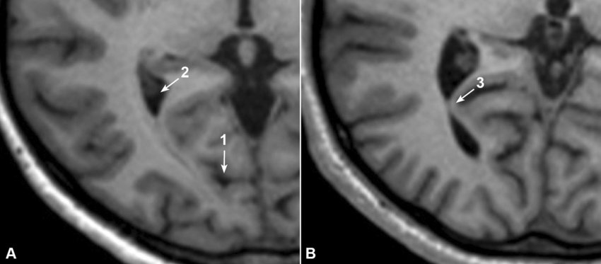 Horizontal MRI showing the calcarine sulcus (a) and the calcar avis (b). 1—Calcarine sulcus. 2—Occipital horn of the lateral ventricle. 3—Calcar avis