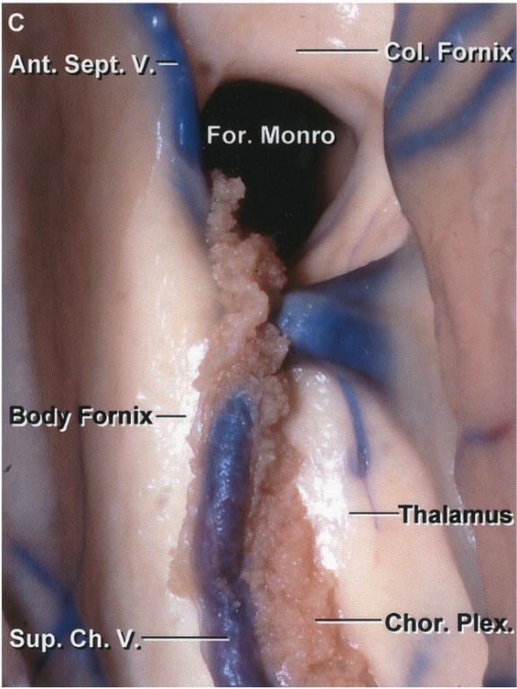 01. Fornix Ant. Sept. V.— For. Monro —•—ThaIamu Chor. pi sup. Ch. V 