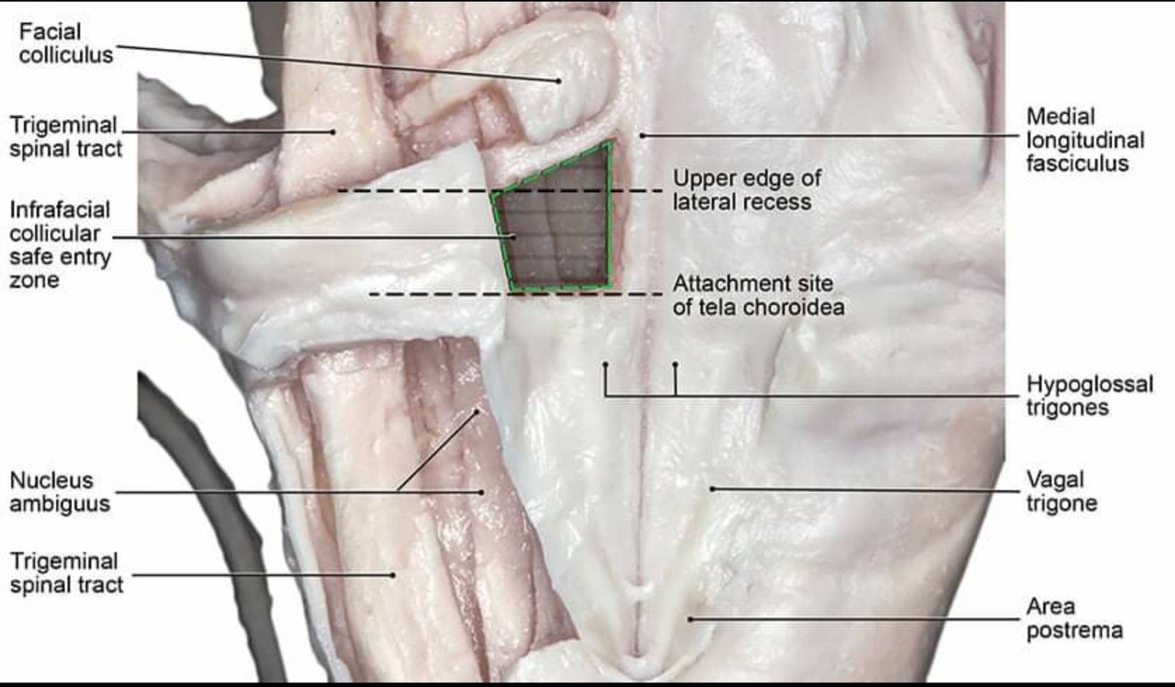 Facial colliculus Trigeminal spinal tract Infrafacial collicular safe entry zone Nucleus ambiguus Trigeminal spinal tract _ Upper edge of lateral recess Attachment site of tela choroidea t, Medial longitudinal fasciculus Hypoglossal trigones Vagal trigone Area postrema 