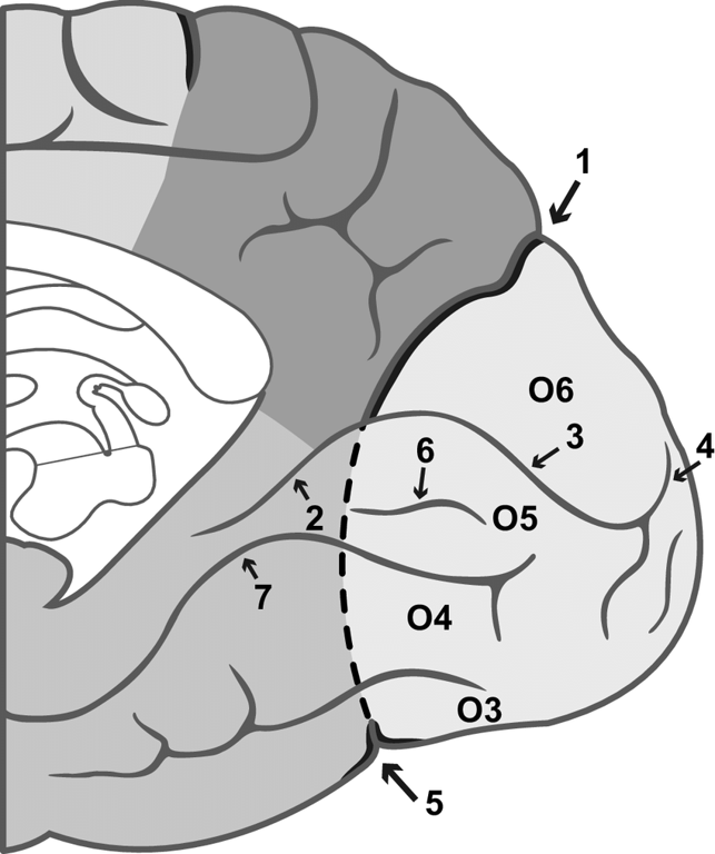 The three segments of the calcarine sulcus according to Duvernoy (8). 1—Parieto-occipital fissure. 2—Anterior part of the calcarine sulcus. 3—Calcarine sulcus proper. 4—Retro-calcarine sulcus, ascending and descending rami. 5—Temporo-occipital fissure. 6—Lingual sulcus. 7—Collateral sulcus (medial occipitotemporal sulcus). O3: Third occipital gyrus. O4: Fourth occipital gyrus. O5: Fifth occipital gyrus (Lingual gyrus); O6: Sixth occipital gyrus (Cuneus)
