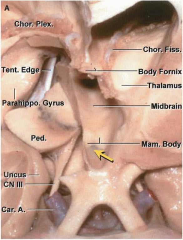 Chor.+lex.. Tent. Edge Pa Uncus 111 Car. A. PO. Gyrus Ped. choiFi Body Fomix Thalamus Midbrai Mam. Bod 