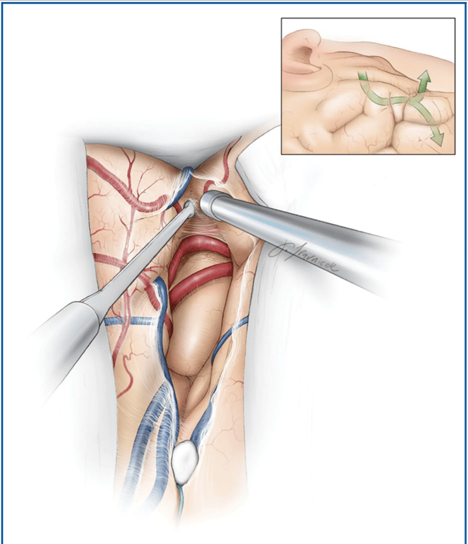 Step 4. The planum polare may be very adherent, and a round knife may be used to sharply identify the dissection and pial planes. Please note the roadmap for the inside-to-outside technique (inset image, green arrows). Used with permission from Neurosurgical Atlas by Aaron Cohen-Gadol, MD.