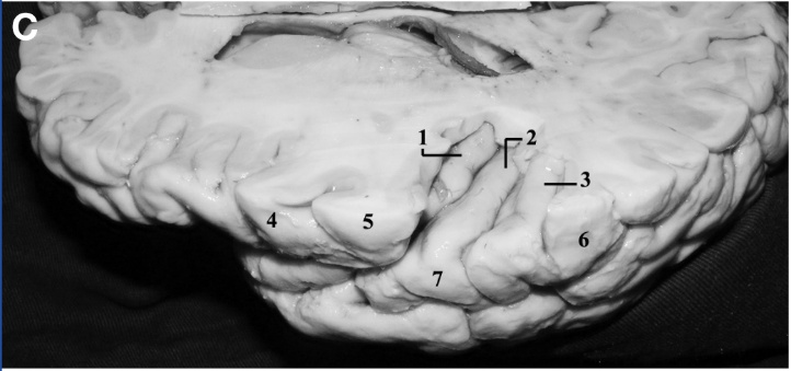 A close-up of a human brain AI-generated content may be incorrect.