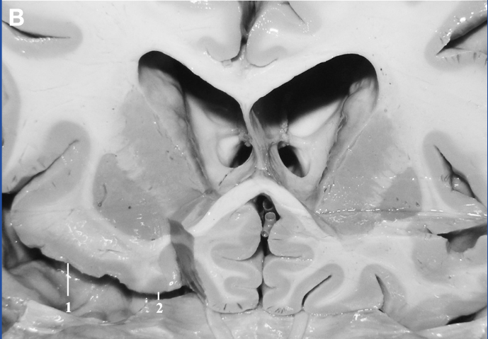 A close-up of a human brain AI-generated content may be incorrect.