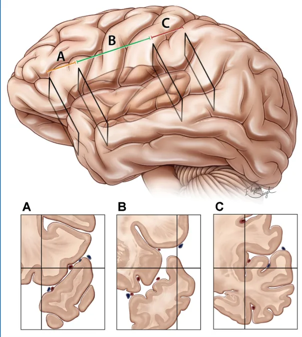 c FIGURE 4. The proximal section of the fissure (vallecula) houses rhe internal carotid artery bifurcation and limen insula, Where the MCA bifurcates into its superior and inferior trunks. The vallecu/a also contains lateral lenticulostriare perforators and the deep Sylvian vein. Opening of the will provide space to reach rhe proximal MCA and internal carotid artery bifurcation territories. The proximal (sphenoidal) section A also includes the area (3-4 cm) Over rhe planum polare where the pial surfaces can be highly adherent, requiring gentle microdissec'ion. The paucity of vessels in this section allows adherence of frontotemporal opercula. The middle (insular) section B is 6 to 7 cm in length and extends from the limen insula to rhe posterior insular point. In this section of the figure, the are interdigitated, possibly simplifying fissure dissection. The posterior (rerroinsular) section C is short (4-5 cm) but deep, and covered by the supramarginal, transverse temporal, and transverse parietal gyri The dissection can be especially challenging at this segment because ofcomplex inrerdig- irations Of the opercula. Used With permission from Neurosurgical Atlas by Aaron Cohen-Gabi, MD. 