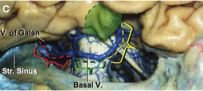 V. pfGa e Str. Sinus Basal V. 